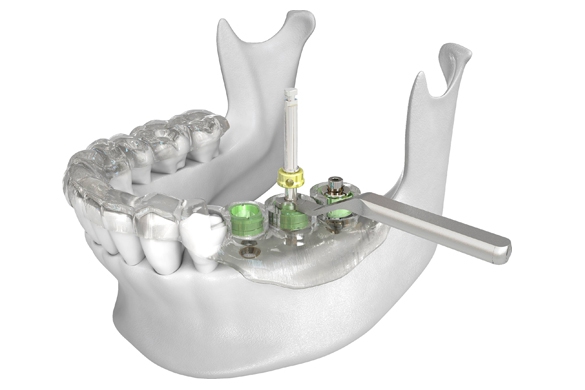 DENTAL IMPLANT WITH GUIDE SURGERY GUIDE
